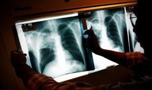 Туберкулез возвращается в Великобританию